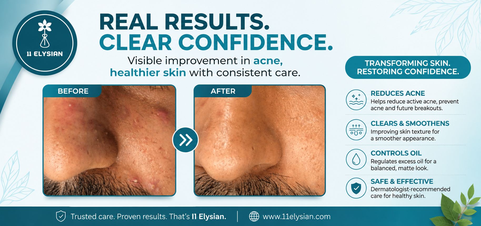 Acne Treatment Near Sector 50, Noida